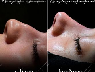 Rinoplastia antes y después - 881412