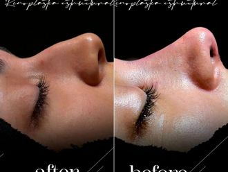 Rinoplastia antes y después - 881413