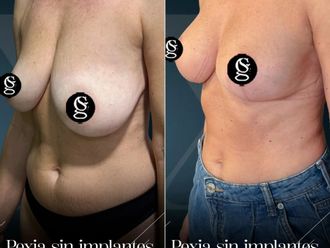 Mastopexia antes y después - 881416