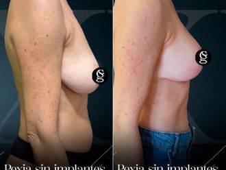 Mastopexia antes y después - 881417