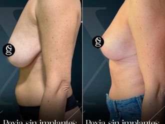 Mastopexia antes y después - 881419