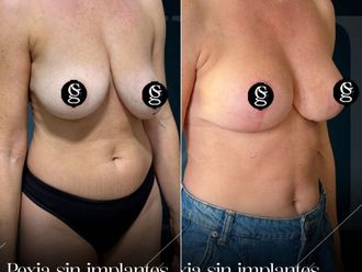 Mastopexia antes y después - 881420