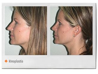Rinoplastia antes y después - 274581