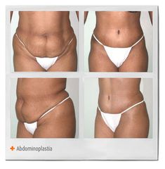 Abdominoplastía