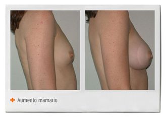 Aumento mamario