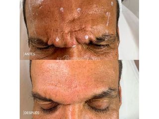 Botox 