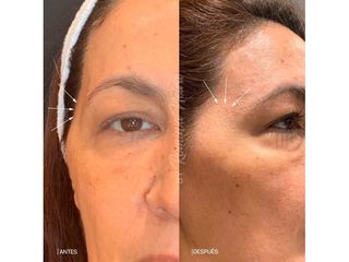 Rejuvenecimiento facial