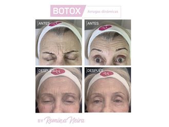 Botox-648087