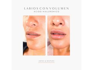 Dra. Romina Neira - Labios con ácido hialurónico