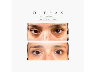 Ojeras - Dra. Romina Neira