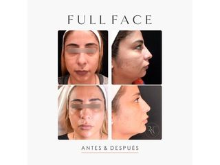 Rejuvenecimiento facial - Dra. Romina Neira