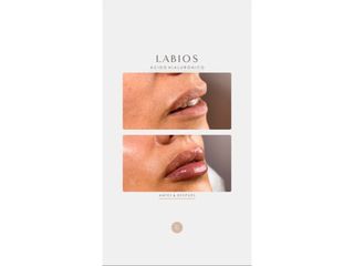 Relleno de labios - Dra. Romina Neira