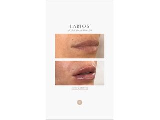 Relleno de labios - Dra. Romina Neira