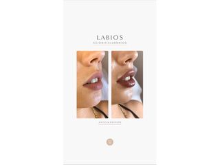 Relleno de labios - Dra. Romina Neira