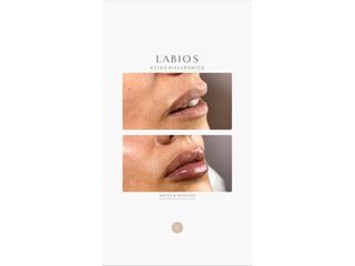 Relleno de labios - Dra. Romina Neira