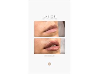 Relleno de labios - Dra. Romina Neira