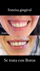 Sonrisa gingival - Dra. Romina Neira