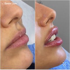 Volumen de labios Dra. Romina Neira