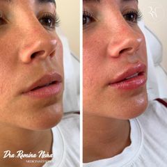 Volumen de labios Dra. Romina Neira