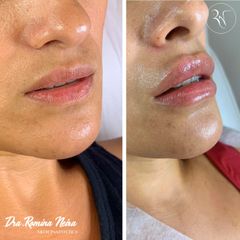 Volumen de labios Dra. Romina Neira