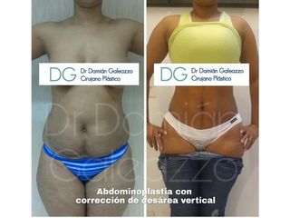 Abdominoplastia - dermo con marcacion abdominal - Dr. Damián Galeazzo