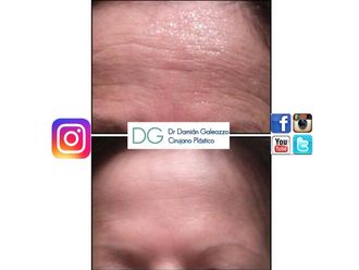 Botox - 633801