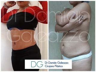 Abdominoplastia-Dr. Galeazzo