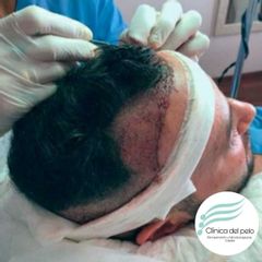 Implante Capilar  - Dr. Damián Galeazzo