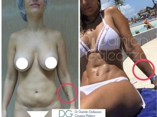 Lipoescultura. Dr Galeazzo
