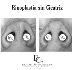 Rinoplastia Dr Galeazzo