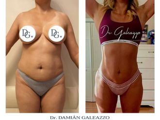 Abdominoplastía antes y después - 739968