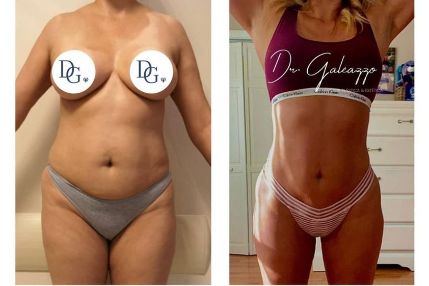 Abdominoplastía antes y después - 739968