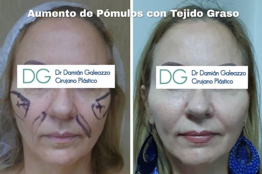Cirugía de pómulos antes y después - 739974