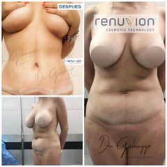 Abdominoplastía con Renuvion - Dr. Damián Galeazzo