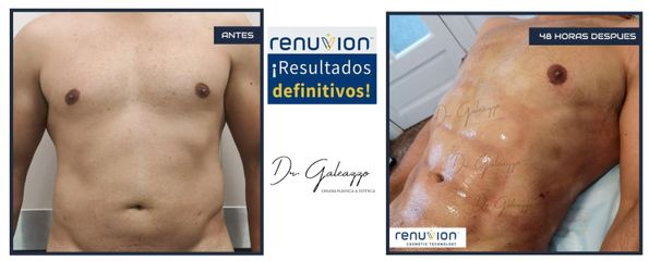 Liposucción - Dr. Damián Galeazzo