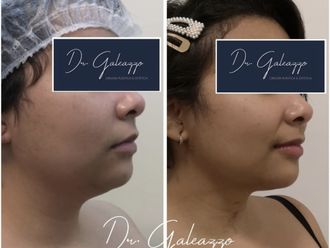 Liposucción - 790827