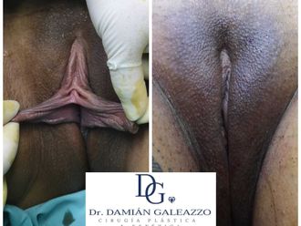 Labioplastia antes y después - 797403