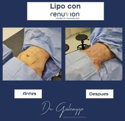 Lipo+Renuvion - Dr Damián Galeazzo y Equipo