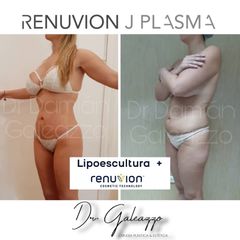 Renuvion J Plasma - Dr Damián Galeazzo y Equipo