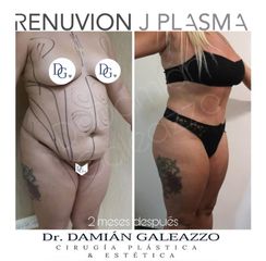 Abdominoplastia - Dr Damian Galeazzo