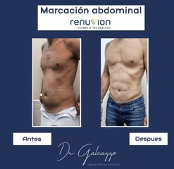 Marcación Abdominal - Dr Damián Galeazzo y Equipo