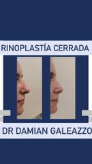 Rinoplastia - Dr Damián Galeazzo y Equipo