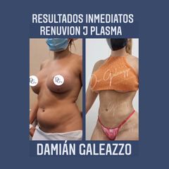 Lipoescultura - Dr Damián Galeazzo y Equipo