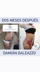 Liposucción - Dr Damián Galeazzo y Equipo