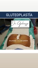 Gluteopastia - Dr. Damián Galeazzo y Equipo