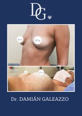 Aumento mamario - Dr. Damián Galeazzo y Equipo