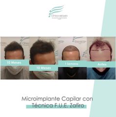 Implante Capilar - Dr. Damián Galeazzo y Equipo