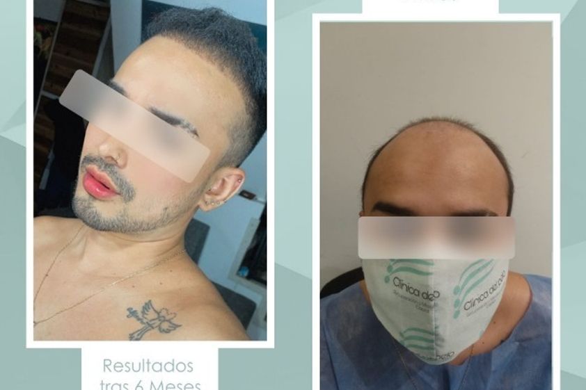 Implante capilar antes y después - 839028
