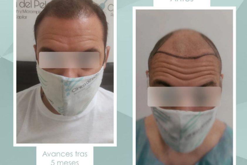 Implante capilar antes y después - 839030