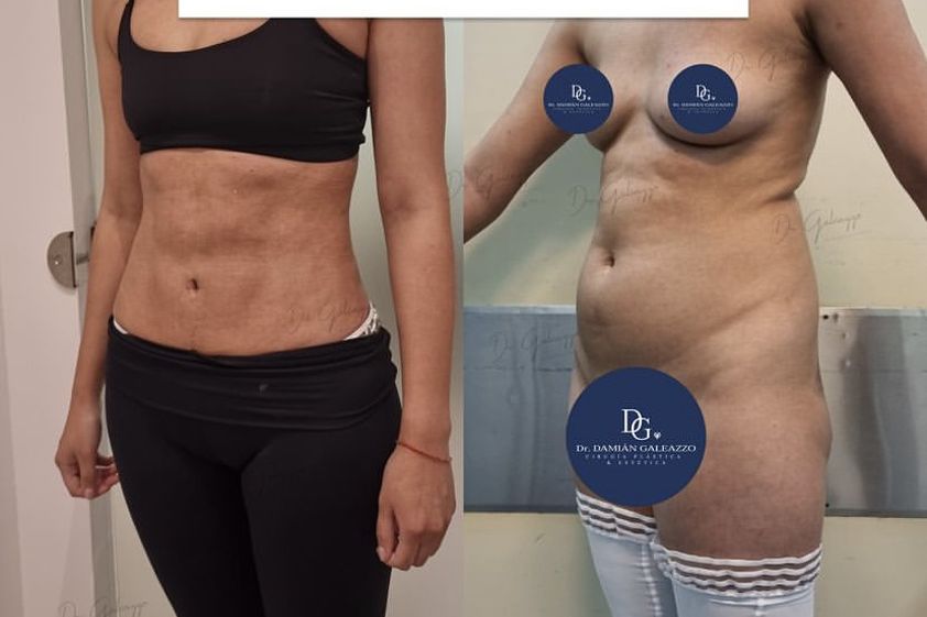Lipoescultura antes y después - 843772